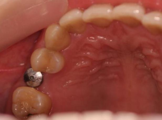 一个牙医对种植牙的良心忠告,种植牙太可怕了真不知道该怎么办