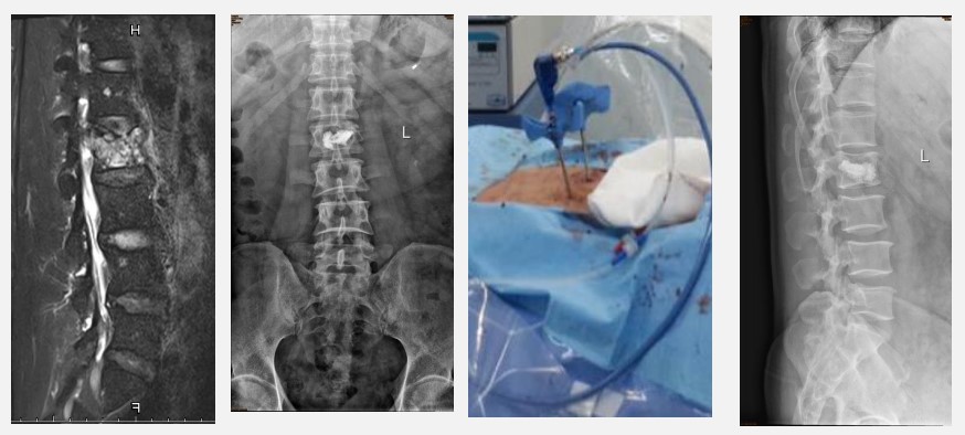 深入骨髓的痛！30年前不能治的骨转移，现在或有3个机会