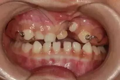 小朋友牙齿地包天矫正方法,牙齿地包天多大矫正最合适