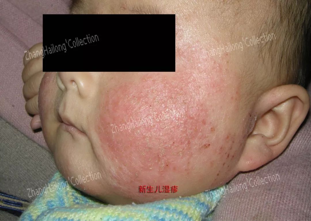 新生儿青春痘,小孩长青春痘怎么办