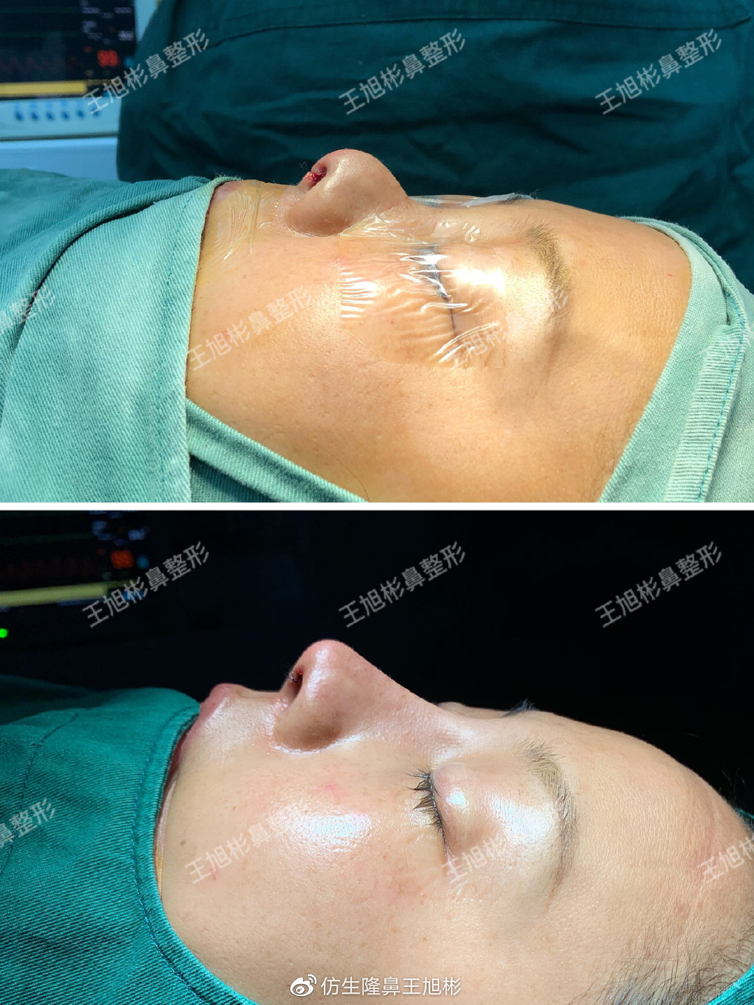 鼻整形最简易方法,鼻孔又大又塌又朝天鼻整形