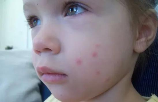 孩子容易被蚊子咬怎样防蚊有效,宝宝总被蚊子叮怎么预防