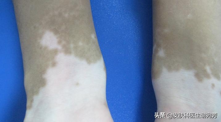 花斑癣白斑和白癜风白斑的区别,长了白斑能自愈是白癜风吗