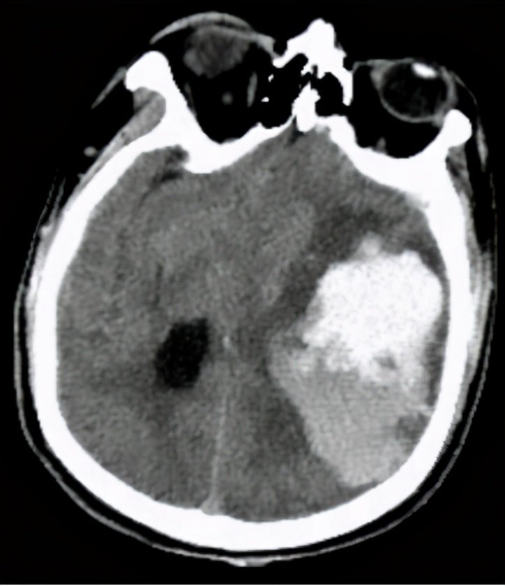 高血压脑出血开颅手术多久清醒,高血压脑出血昏迷要尽快手术吗