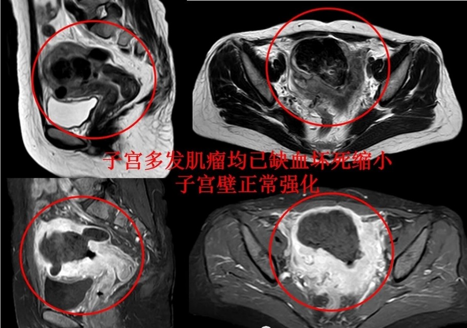 子宫肌瘤粘膜下肌瘤和肌壁间肌瘤,发现子宫肌瘤是大手术吗
