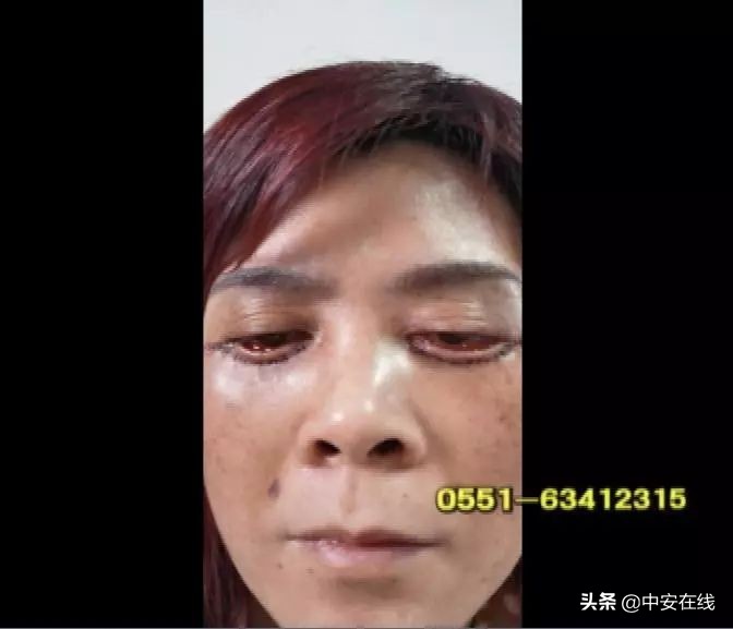 安徽巢湖:宾馆里做美容手术致眼睛无法闭合医生身份成谜