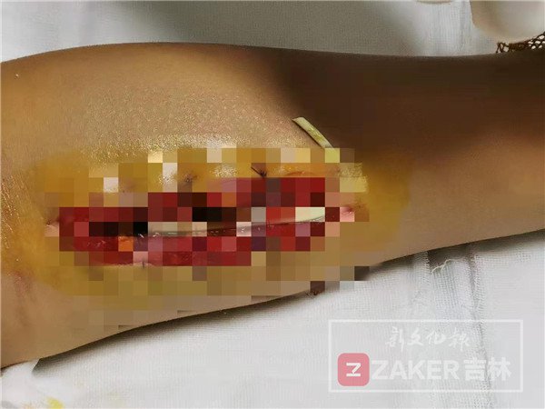 男孩被毒蛇咬伤送医时宁死不说,男孩被毒蛇咬伤中蛇毒