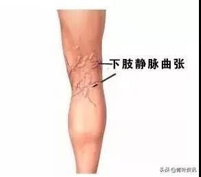 蚯蚓腿微创手术多少钱,蚯蚓腿手术费用多少