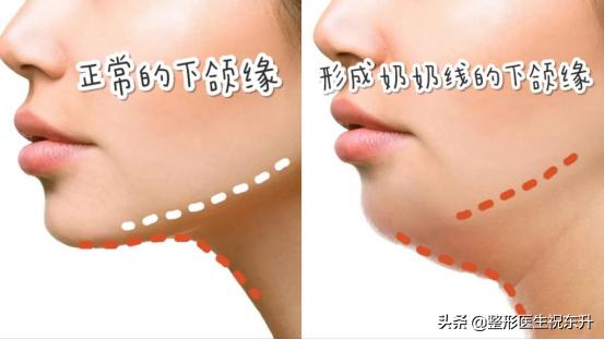 下颌线吸脂变化,双下巴下颌线吸脂对比图