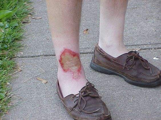 烧伤快好了痒发红发热是怎么回事,烧伤伤口痒