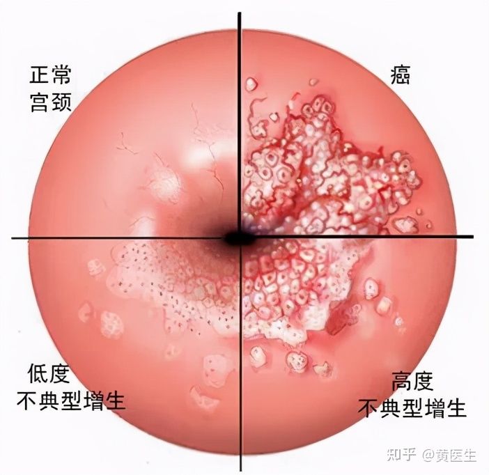 十个问题:让你三分钟了解HPV