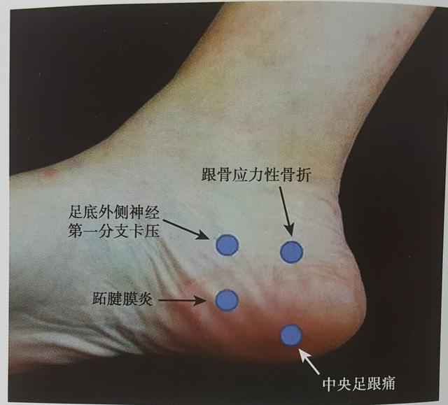 骨刺外翻什么症状,骨刺会导致拇指外翻吗
