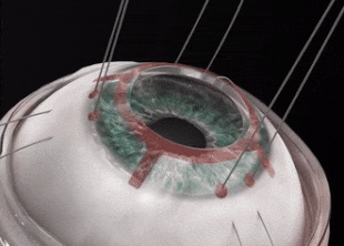 世界第一例眼角膜移植手术,我国首例眼角膜移植手术