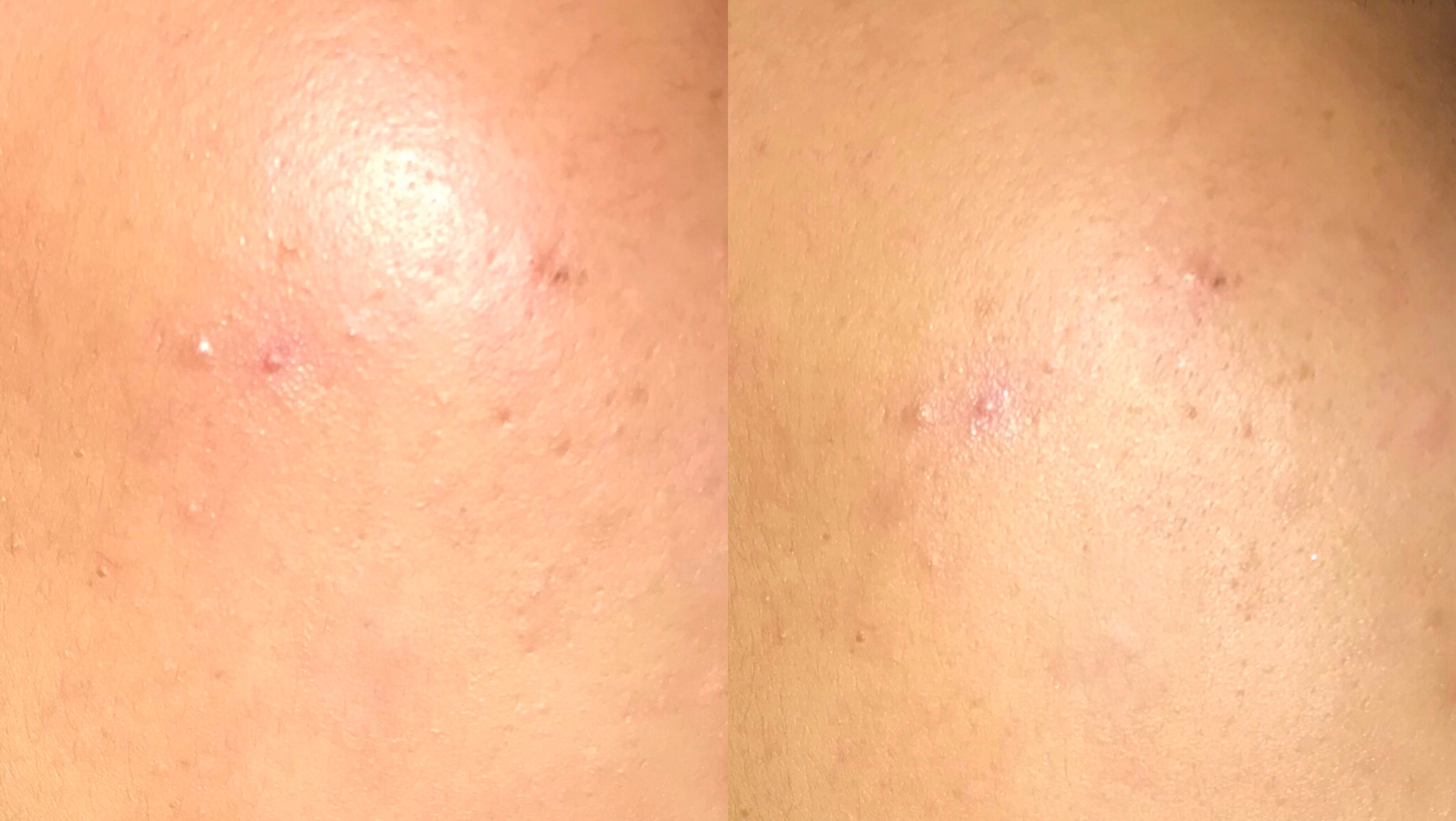 敏感肌*血丝红**终于有救了！敷尔佳新款绿膜，医美面膜王者不服不行