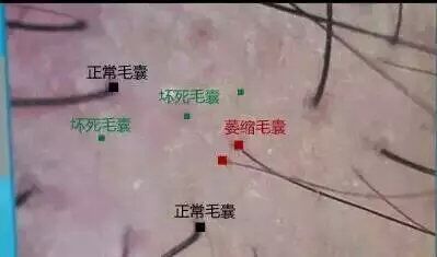 什么比脱发还严重？毛囊退化，毛囊闭合，毛囊萎缩都有什么区别？