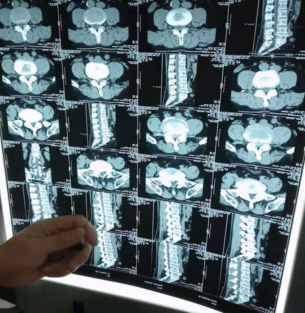 腰椎管狭窄的病例,腰椎管狭窄成因和治疗方法