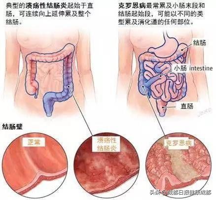 克罗恩罕见病,儿童克罗恩病怎么确诊