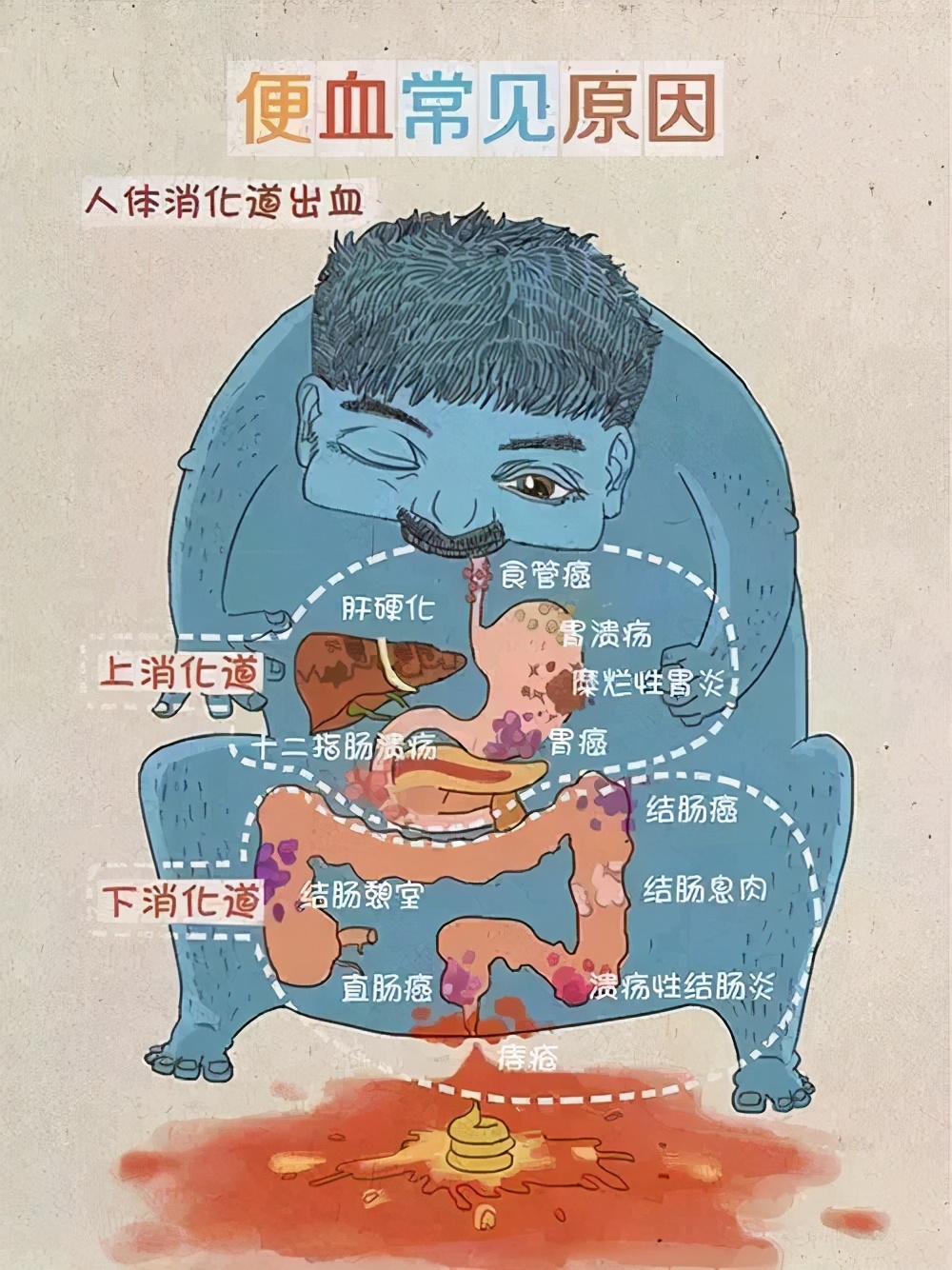 大便出血有轻重！若是出现这4种情况，一定得去看医生