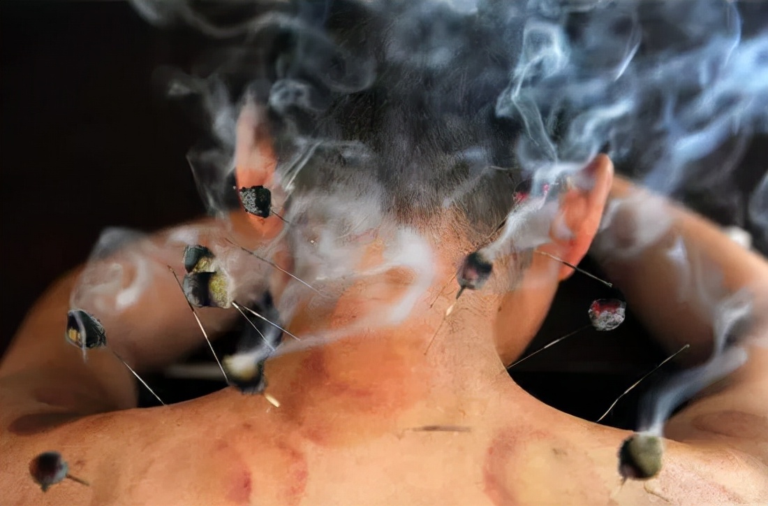 中医艾灸疗法课程,中医灸疗法大全