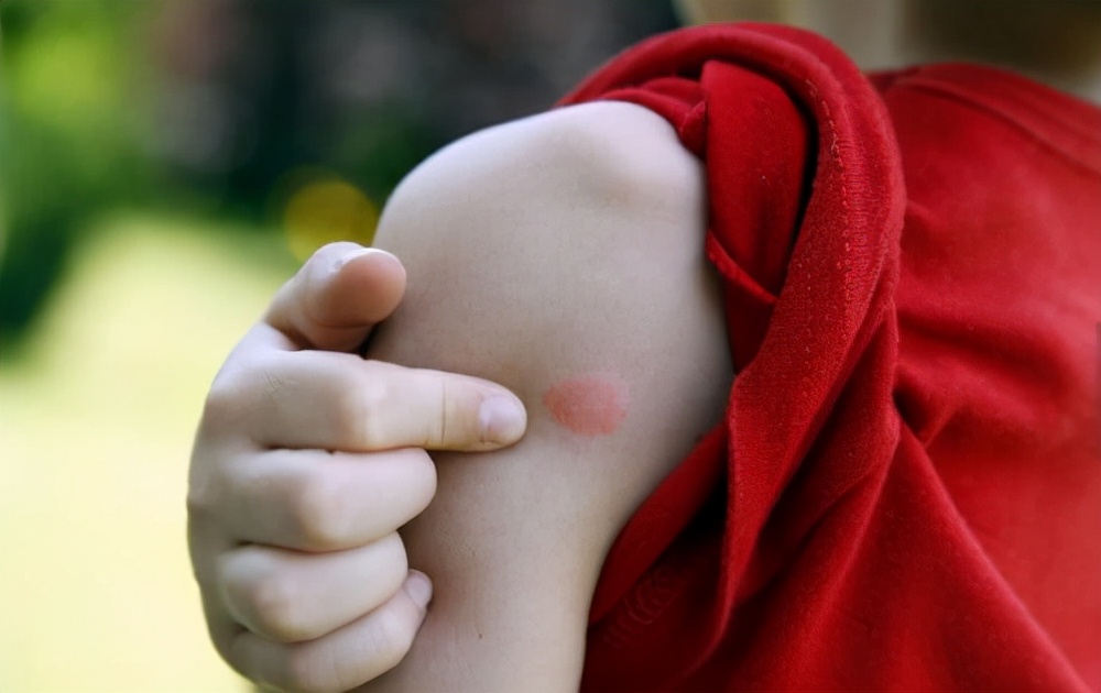 蚊虫叮咬教您几招止痒简单又快速,蚊虫叮咬怎么止痒最快最有效