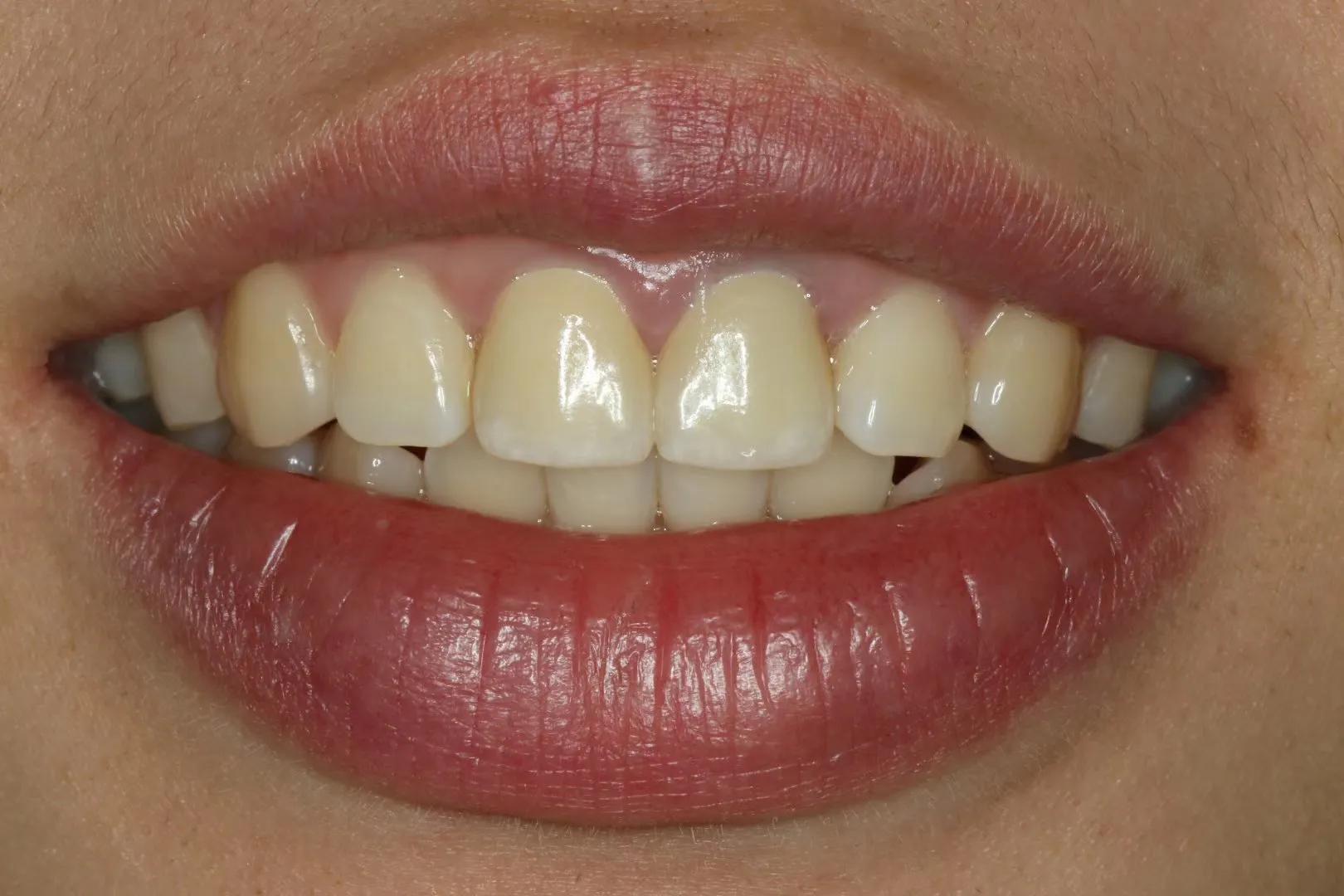 牙齿凹槽有黑色污垢是怎么回事,牙齿里面剔出来的残渣怎么是臭的