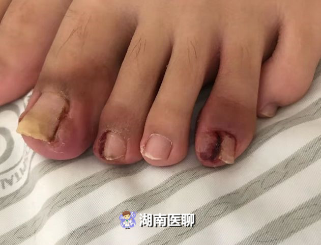 勤修脚能治好甲沟炎吗,勤剪指甲卫生常识