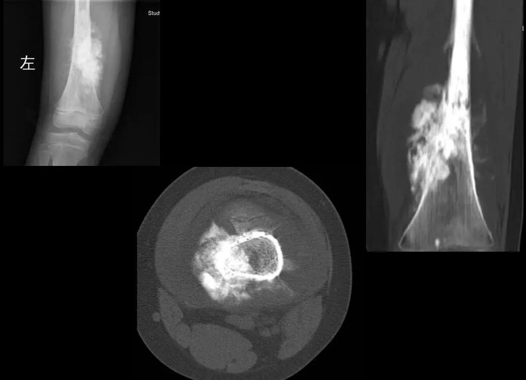骨科恶性肿瘤骨肉瘤,骨旁骨肉瘤恶性程度