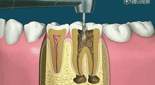 大连口腔视频,大连市口腔医院根管治疗