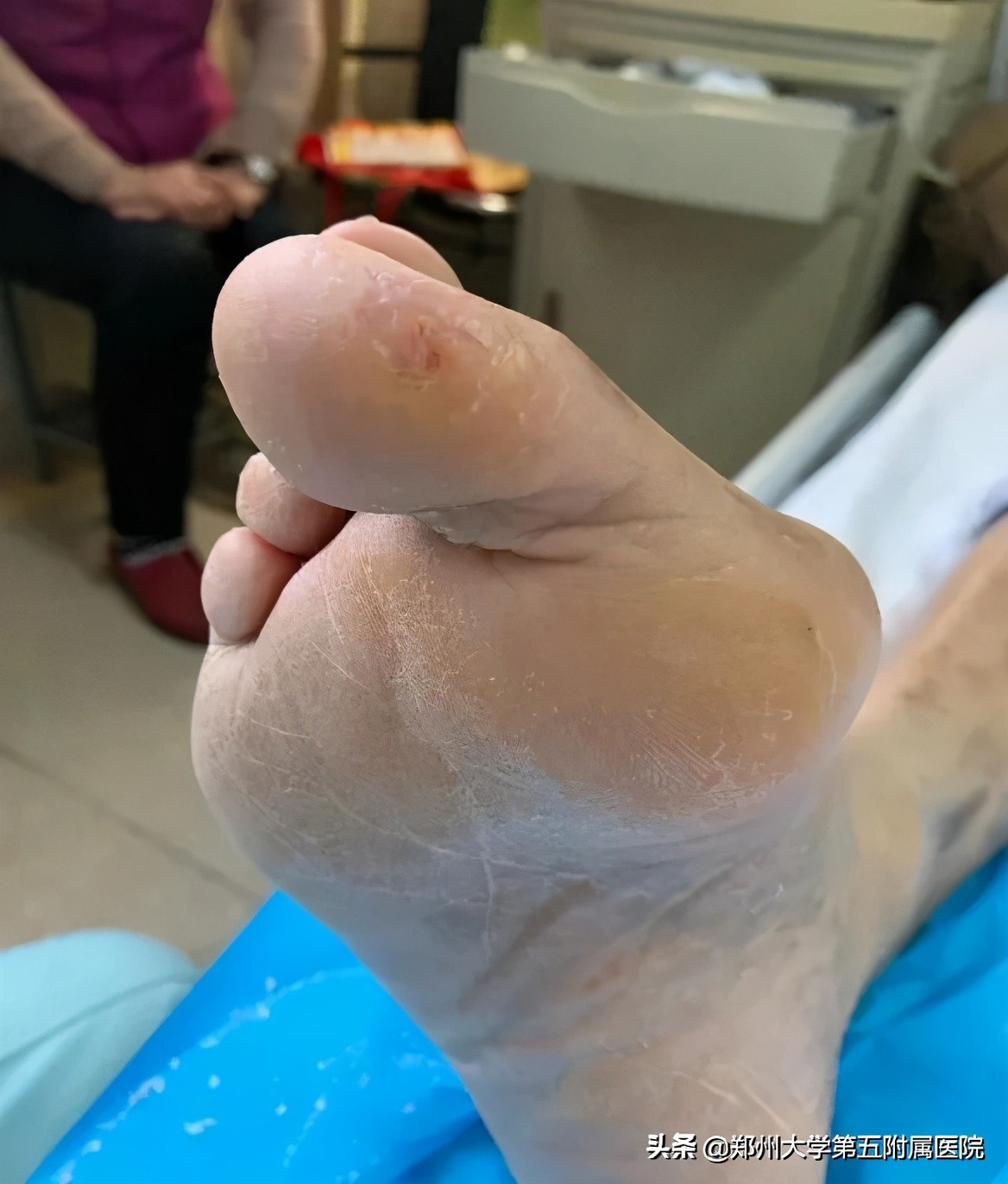 老茧疼痛怎么去除,去除手部老茧