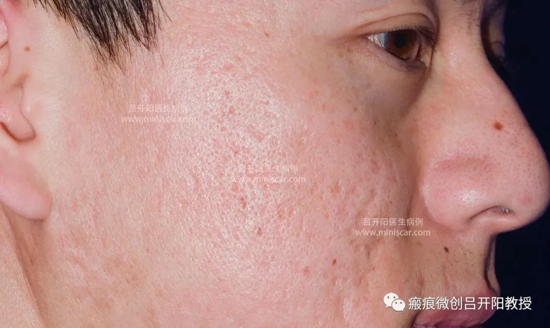 强脉冲激光治疗脸部视频,点阵激光嫩肤