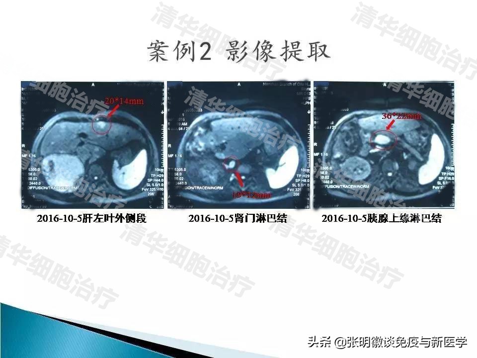 免疫治疗对肝癌晚期有效吗,肝癌晚期血小板低可以免疫治疗吗