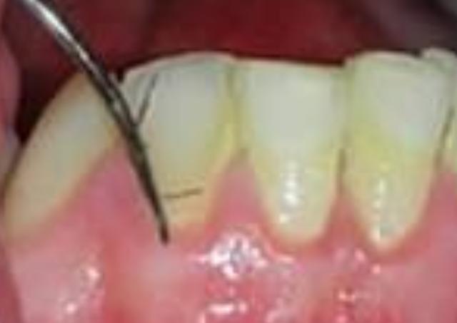 女孩牙龈罕见长出毛发,医生:之前都是男性