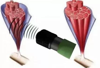 体外冲击波碎石对肾有损伤吗,体外冲击波治疗筋膜损伤