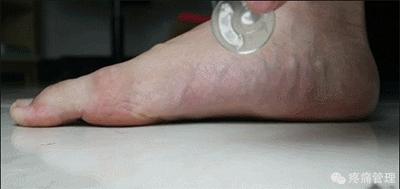 专门改善扁平足的运动,站着改善小腿外翻