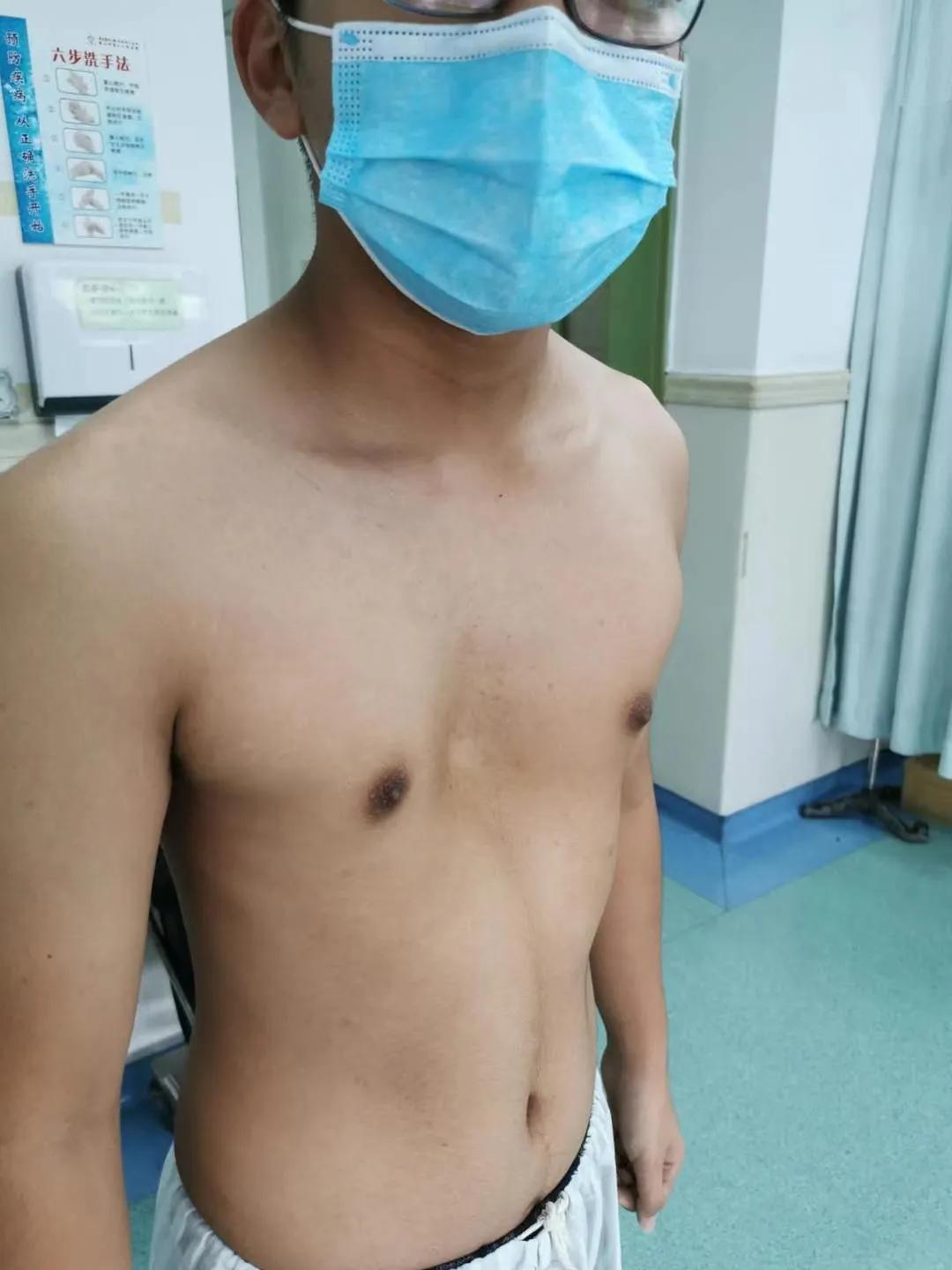 胸前肋骨两侧凹陷属于漏斗胸吗,胸口凹陷一个小坑一定是漏斗胸吗