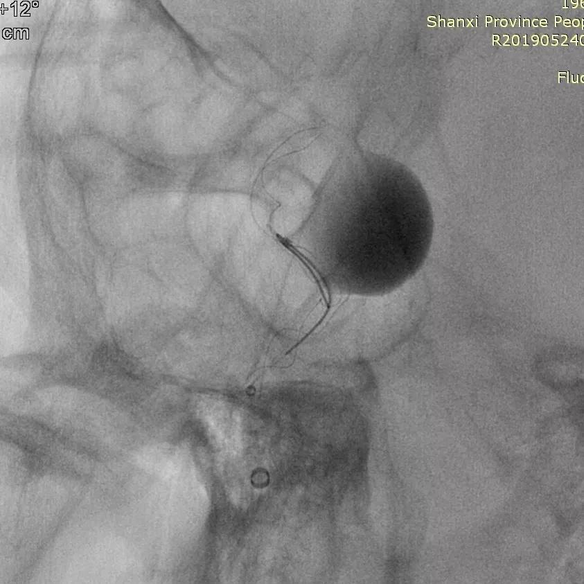 山西省人民医院任少华教授,山西省人民医院任少华