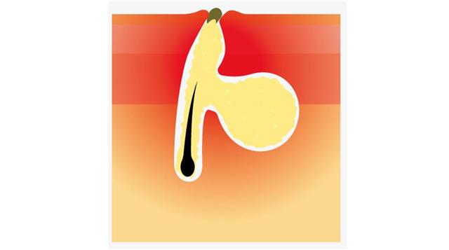 反孔大作战专治你的毛孔粗大