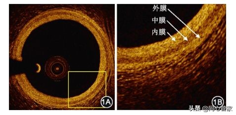 造影如何判断是血栓还是斑块,斑块和血栓ct区别