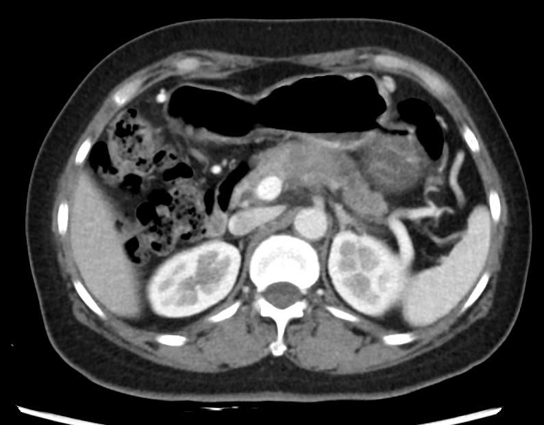 胰腺癌胃痛是什么情况,胃痛和胰腺炎区别与图片