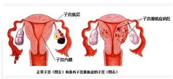 子宫腺肌症怀孕后一定要这么做!