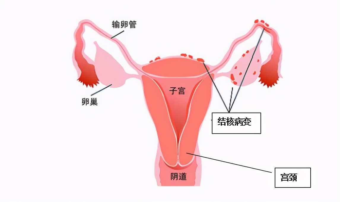 女性得了结核,女性有结核能做试管吗