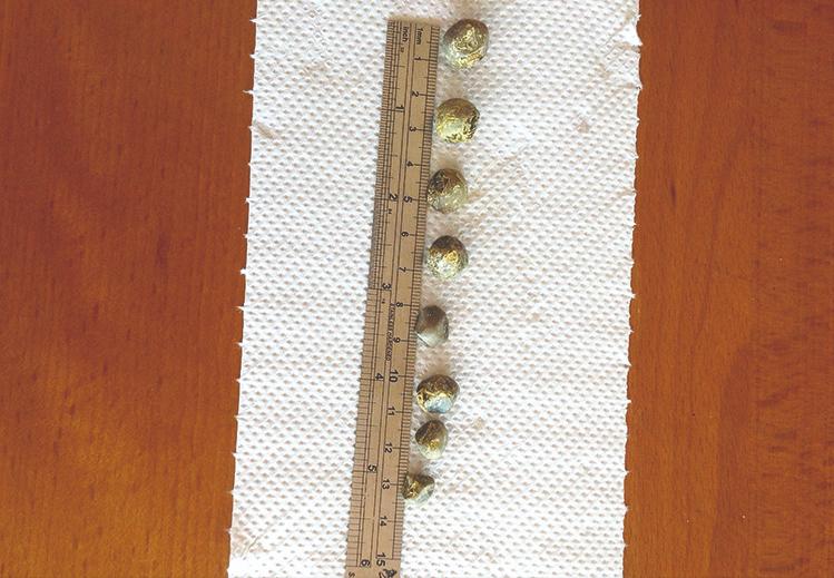 体检出胆结石无症状怎么办,体检胆结石没症状怎么办