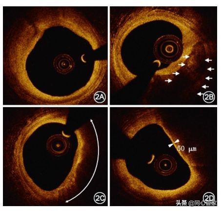 造影如何判断是血栓还是斑块,斑块和血栓ct区别