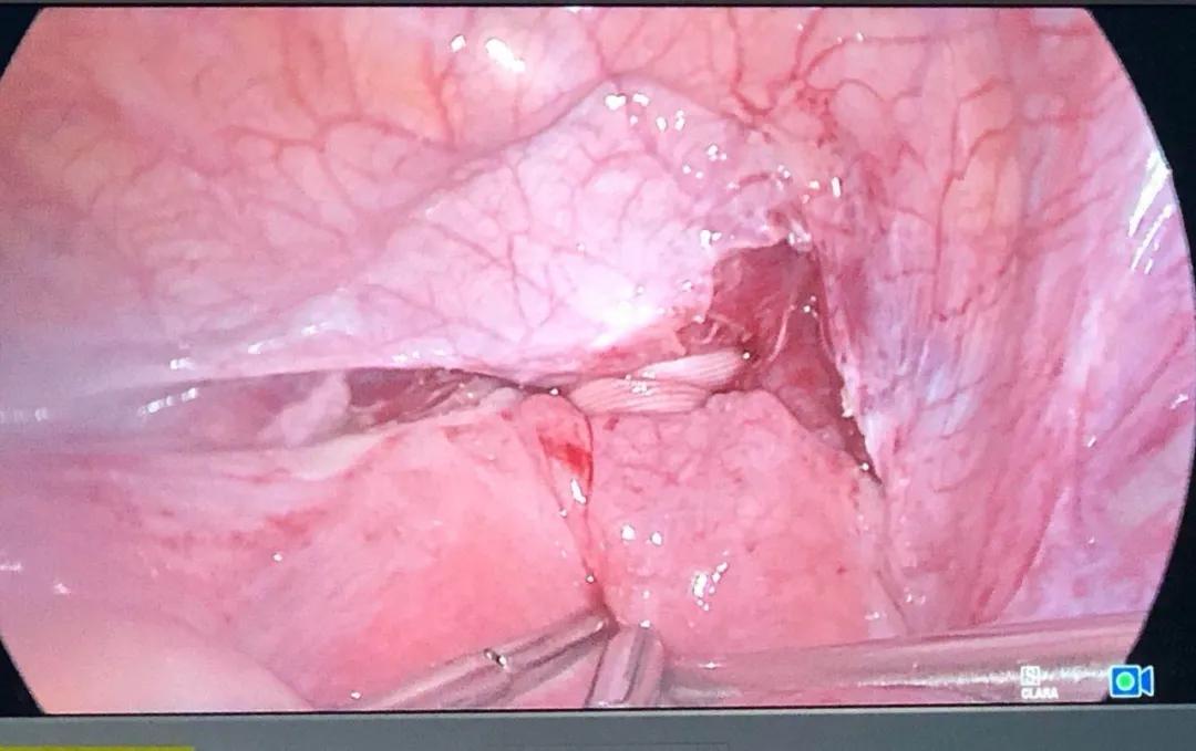 市一技术｜新生命的保护圈——我院开展腹腔镜下宫颈环扎