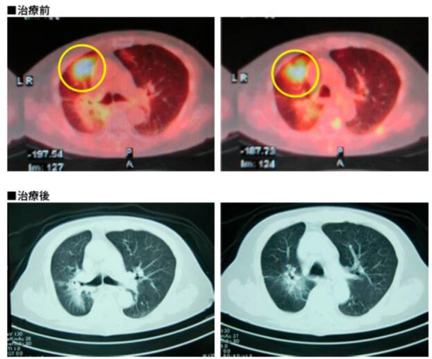 为什么很多人都选择去国外治病,出国治疗癌症首先哪个国家费用少