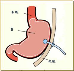 食道癌吞咽困难怎样改善,食道癌吞咽困难的妙方中医