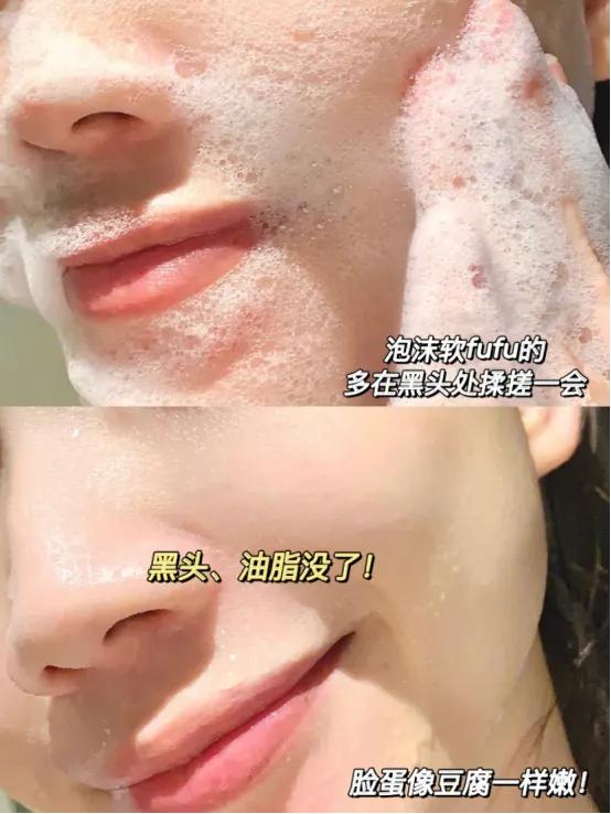 黑头毛孔粗大变细腻,皮肤黑头多毛孔大油脂分泌旺盛