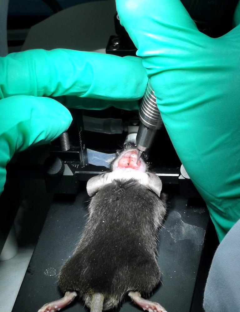 晶体植入手术的分享,可调微丝阵列电极