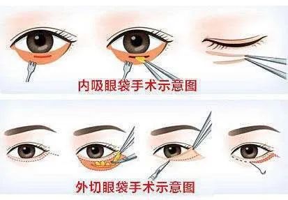 眼袋泪沟黑眼圈卧蚕是怎么形成的,如何分清楚卧蚕泪沟眼袋黑眼圈