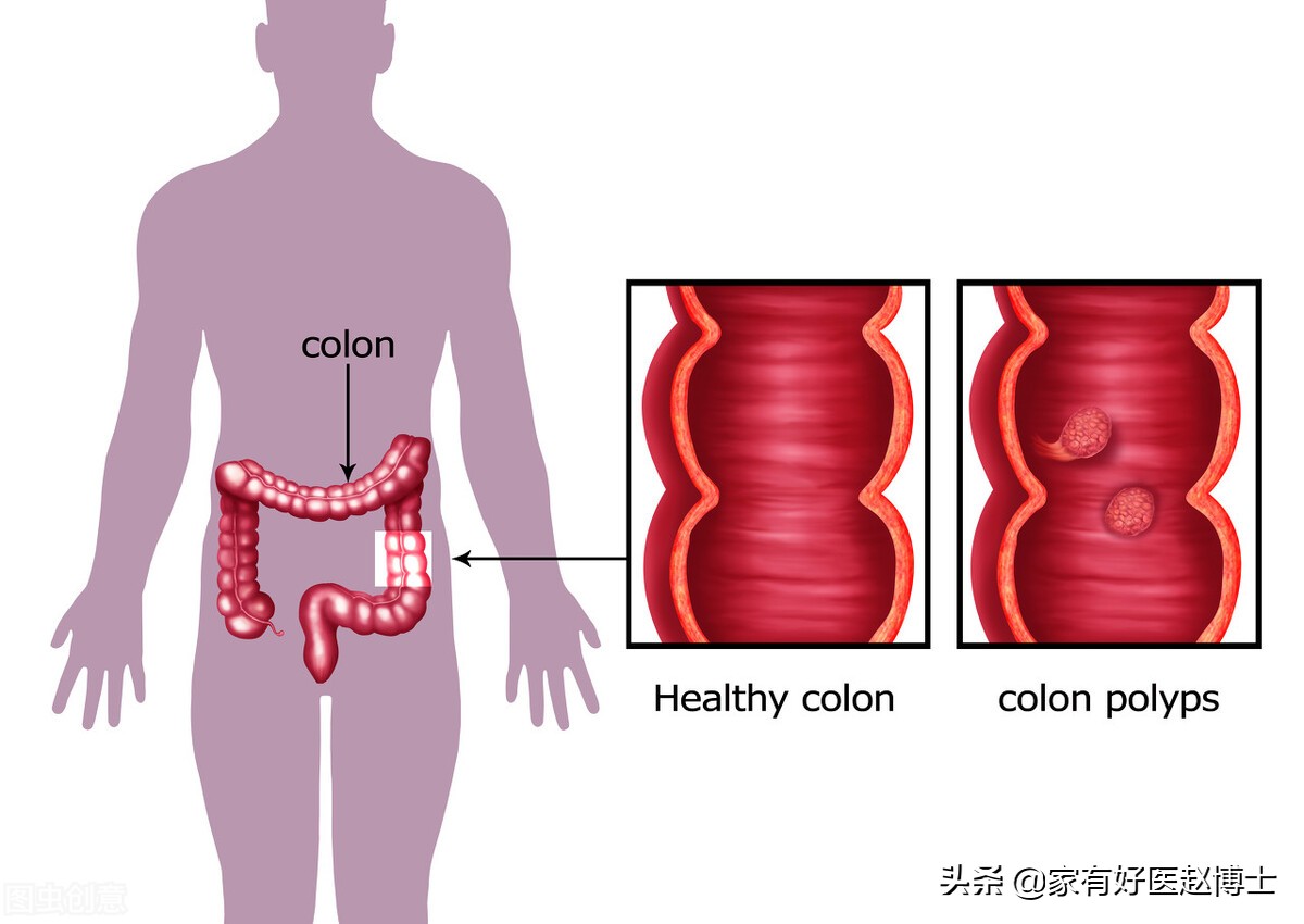 最常见5类息肉每个人都可能有，哪些无癌变风险，哪些需要切除？